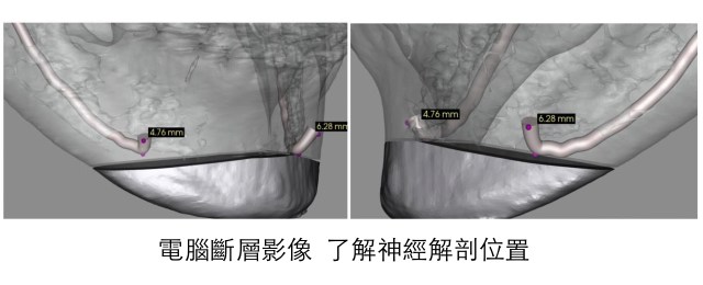 下巴整形畫龍點睛.001