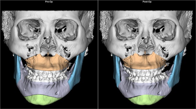 asymmetry before after AP