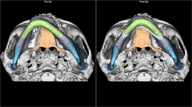 asymmetry before after BASAL