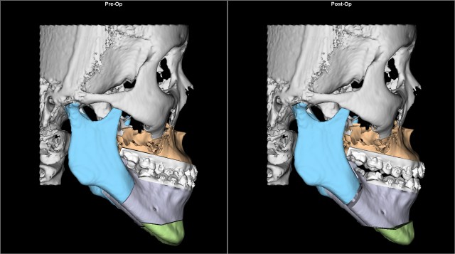 asymmetry before after Lat