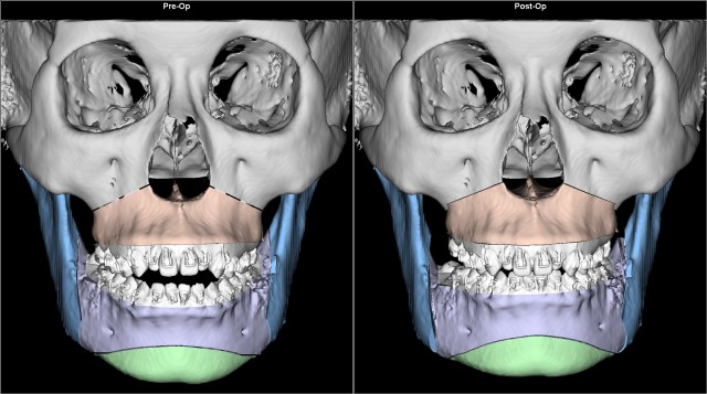 class I open bite before after AP