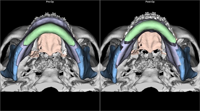 class I open bite before after BASAL