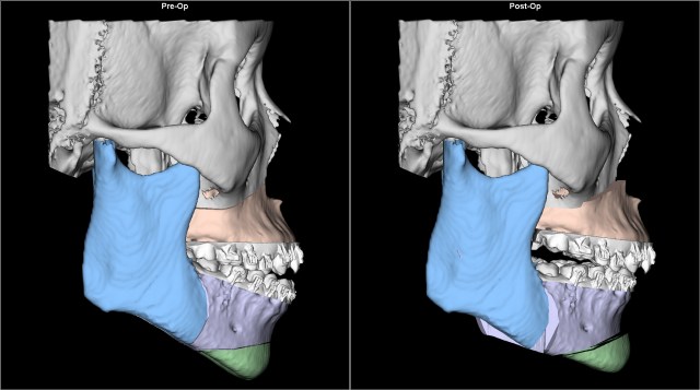 class I open bite before after Lat