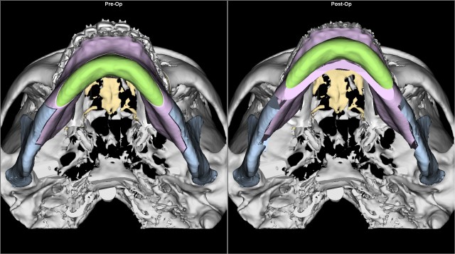 class II retruded chin gummy smile before after BASAL
