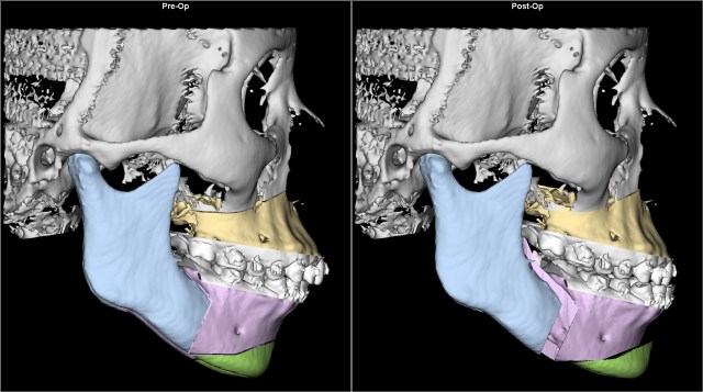 class II retruded chin gummy smile before after Lat