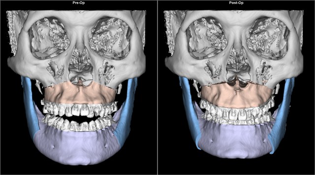 class III anterior open bite before after AP