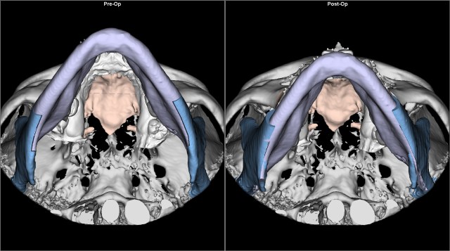 class III anterior open bite before after BASAL