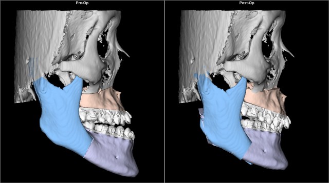 class III anterior open bite before after Lat