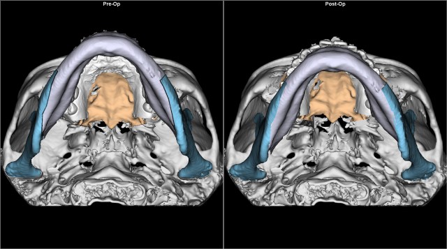 class III anterior reverse bite before after BASAL