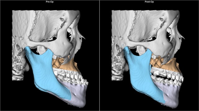class III anterior reverse bite before after Lat