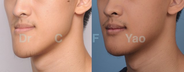 class III oblique 02.001