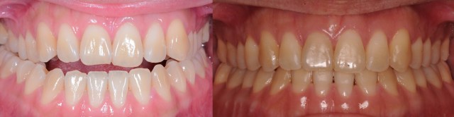 occlusion photo 01.001