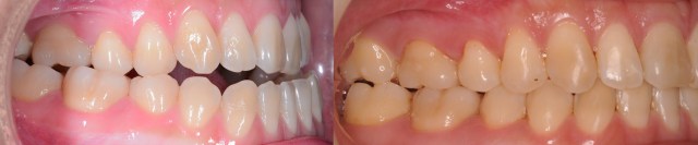 R occlusion photo 01.001