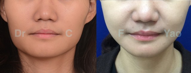 facial contouring 01 AP.001