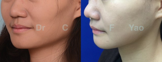 facial contouring 01 L oblique.001