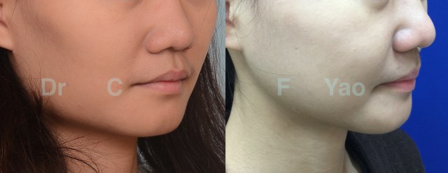 facial contouring 01 R oblique.001