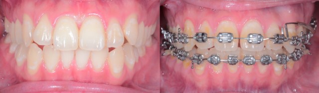 Intraoral Frontal.001