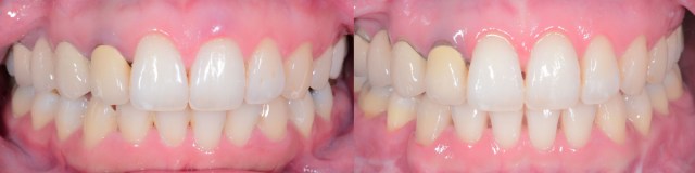 Intraoral Frontal.001