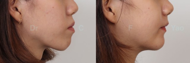 Bimax asymmetry VME retruded chin.002