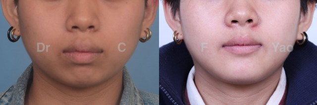 Bimax chin retrusion.001