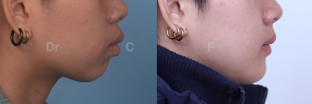 Bimax chin retrusion.002