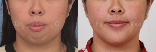 Class II maxillary protrusion.001