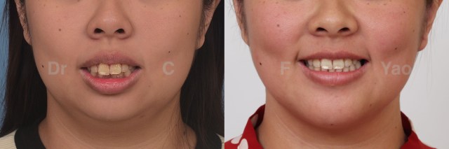 Class II maxillary protrusion.002