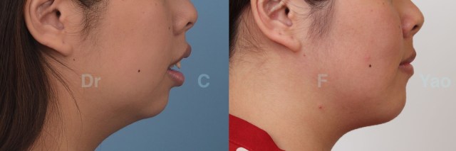 Class II maxillary protrusion.003