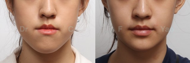 class III open bite.001