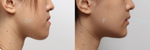 class III open bite.003