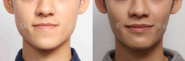 class III reverse bite male.001