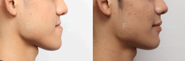 class III reverse bite male.003